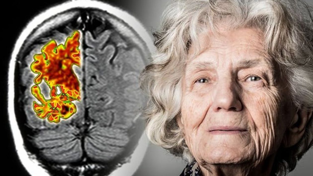 Alzheimerin