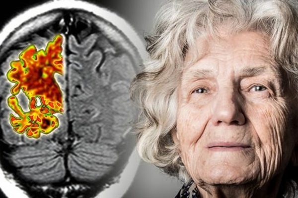 Alzheimerin